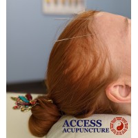 Access Acupuncture logo - Similar company to Access Acupuncture