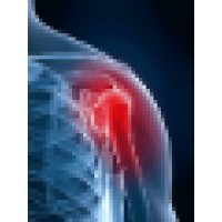 Unfrozen Shoulder