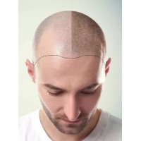 Greffe de Cheveux logo - Similar company to Nht Europe